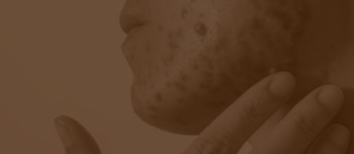 Adolescente em avaliação de alterações hormonais e de pele